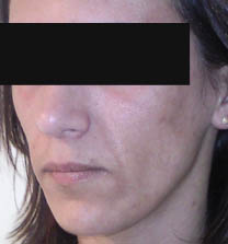 avant lipostucture du visage