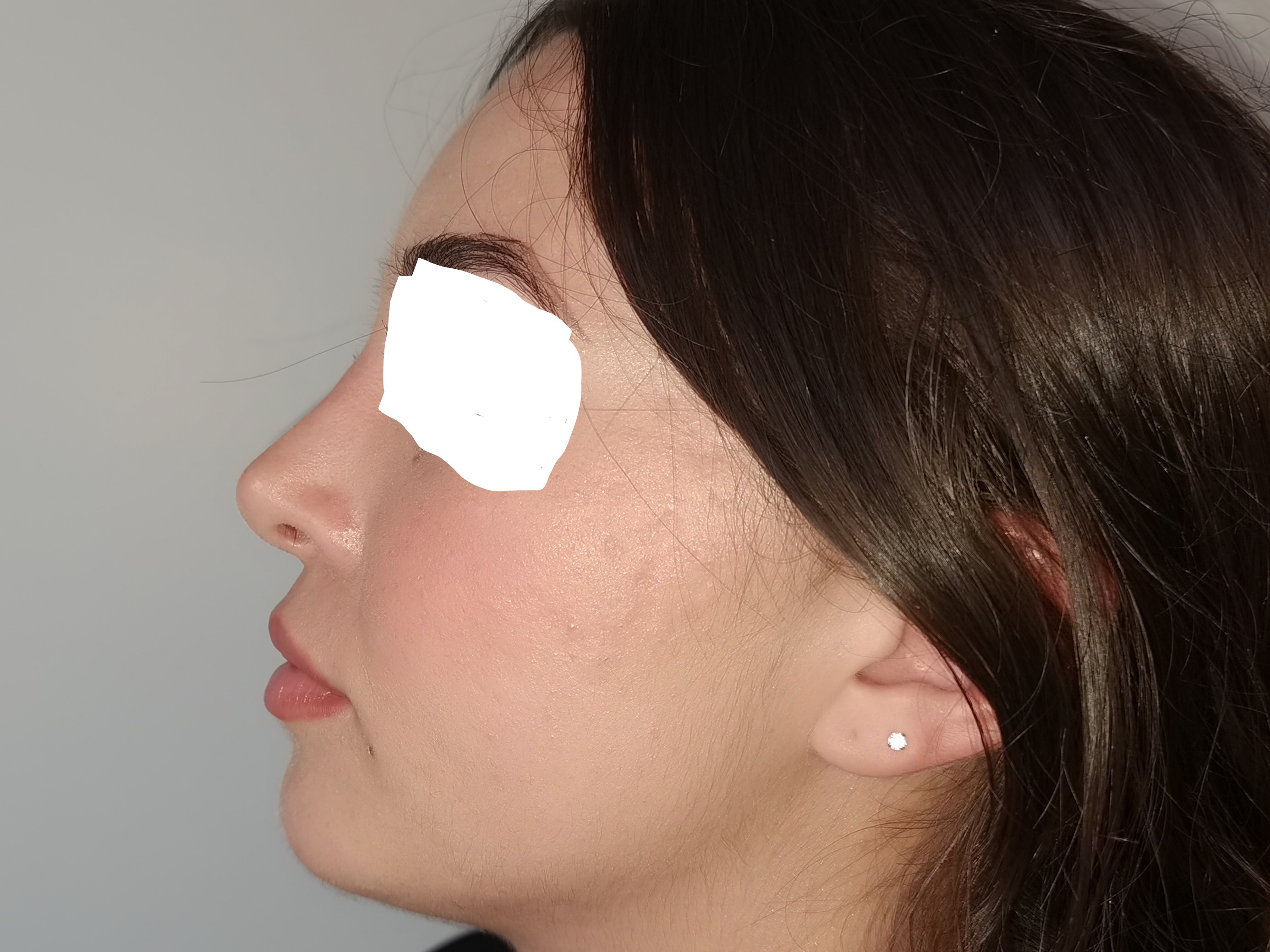 APRES LA RHINOPLASTIE