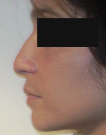 avant rhinoplastie