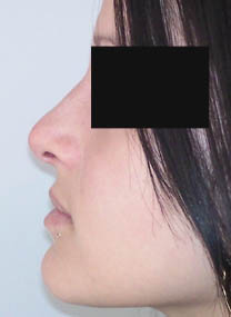 après rhinoplastie