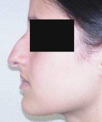 avant rhinoplastie