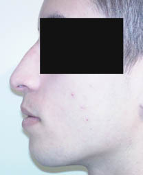 avant rhinoplastie