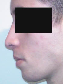 après rhinoplastie