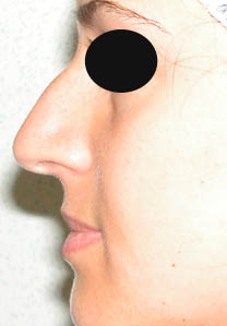 Avant la rhinoplastie