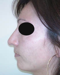 Avant rhinoplastie