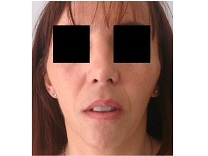 RHINOPLASTIE PROFILOPLASTIE MENTON POSTOP