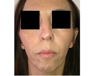 RHINOPLASTIE PROFILOPLASTIE MENTON PREOP