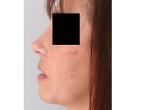 RHINOPLASTIE PROFILOPLASTIE MENTON POSTOP